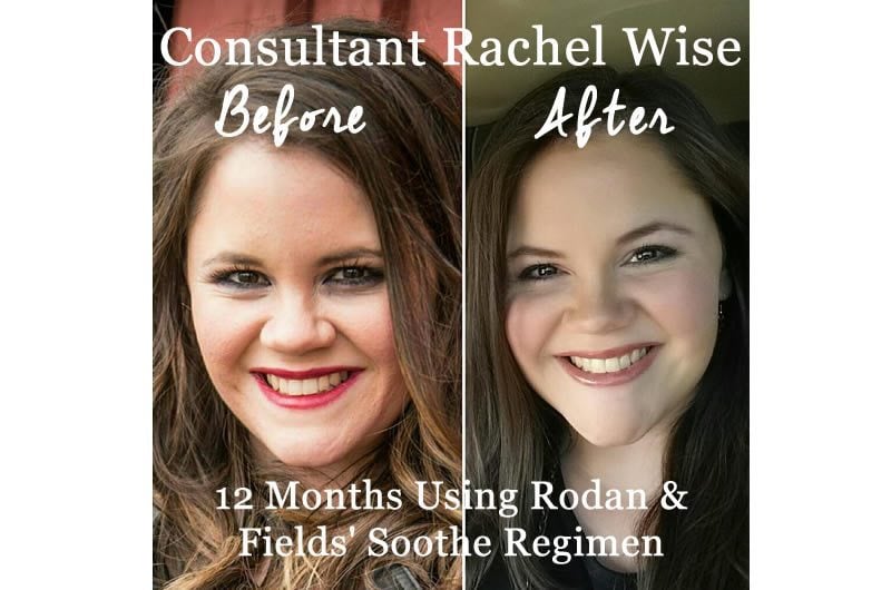 Rodan And Fields Soothe Regimen Before And After