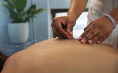 5 Reasons to Get Acupuncture Before Your Wedding