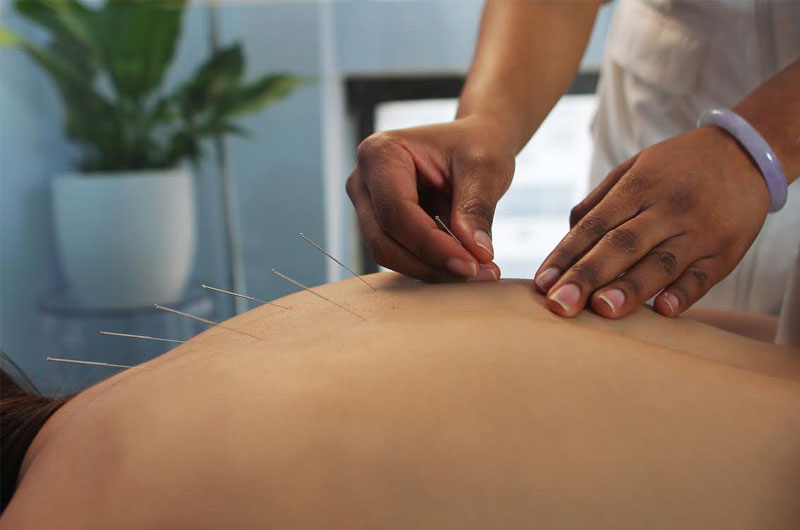 5 Reasons to Get Acupuncture Before Your Wedding